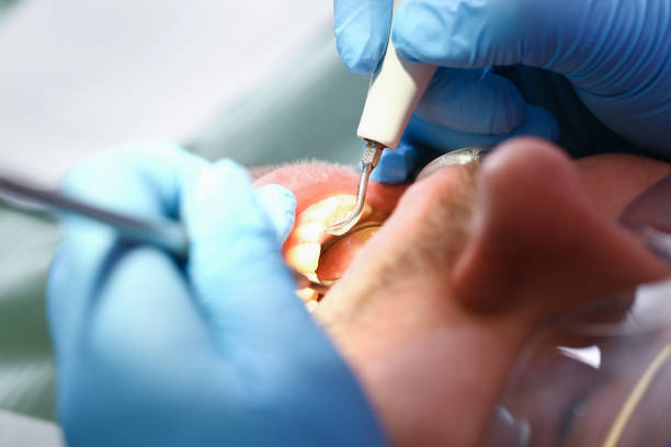 Best Chipped Tooth Repair Near Me  in Rochester, MI